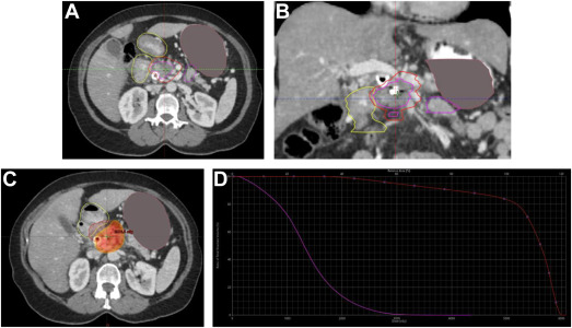 Current State and Future Directions of Radiation Therapy for Pancreas Adenocarcinoma