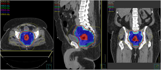 Advances in Radiotherapy for Rectal Cancer