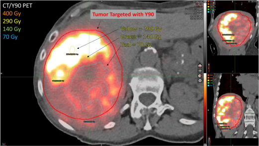 Advances in Radiation Therapy for Primary Liver Cancer