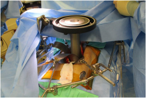 Intraoperative Radiation Therapy for Gastrointestinal Malignancies