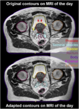 Advances in MRI-Guided Radiation Therapy