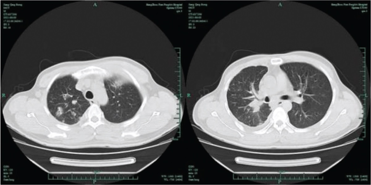 Pulmonary co-infection with Cryptococcus neoformans and Mycobacterium tuberculosis in a middle-aged male, case report and literature review