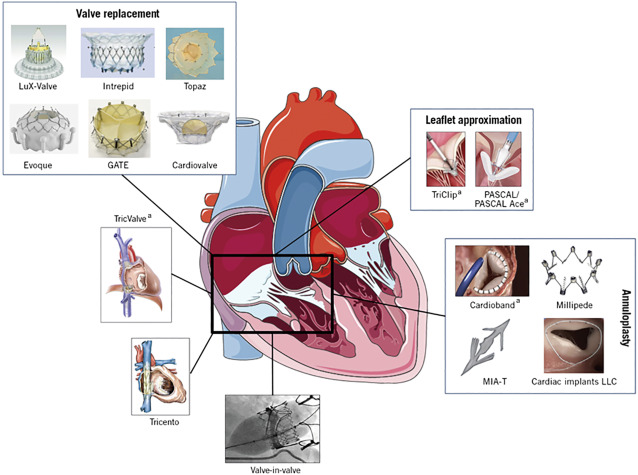 Valvular Heart Failure due to Tricuspid Regurgitation