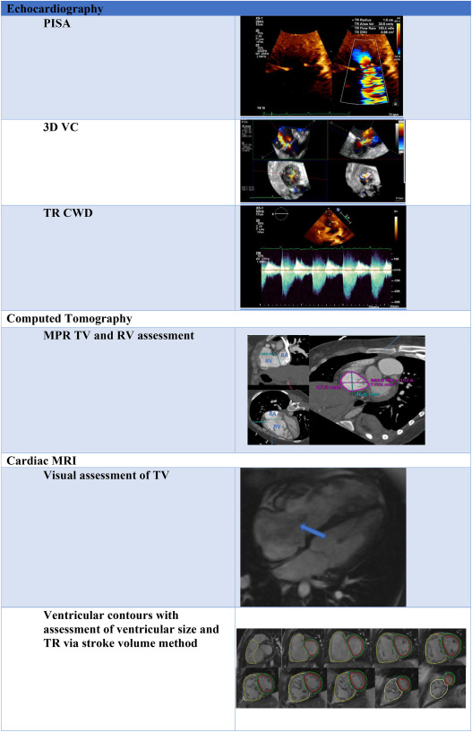 Assessment of Right Ventricle Function and Tricuspid Regurgitation in Heart Failure: Current Advances in Diagnosis and Imaging