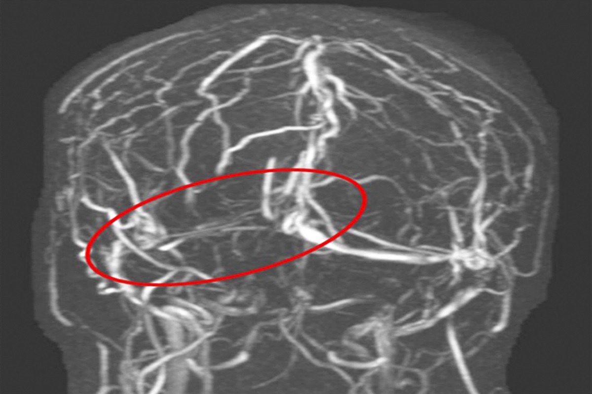 Case Report: Papilledema Secondary to Cerebral Venous Sinus Thrombosis after Severe COVID-19 Infection