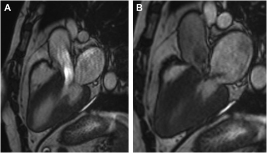 Imaging in Hypertrophic Cardiomyopathy: Beyond Risk Stratification