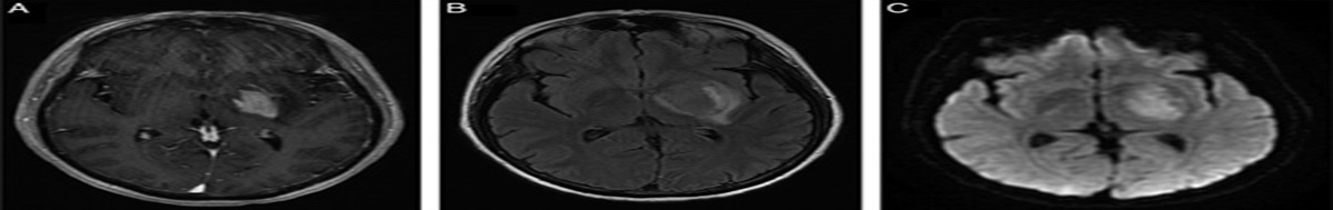 From the ER to the OR: Initial Evaluation of Primary Central Nervous System Lymphoma