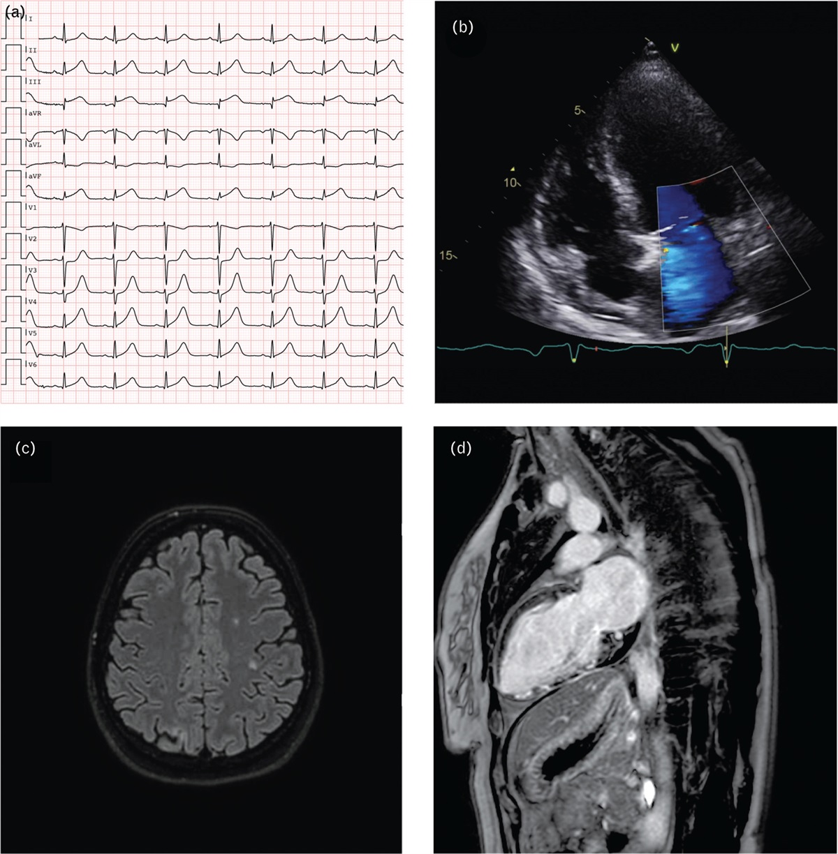 Catastrophic antiphospholipid syndrome immediately after coronary angiography: the unexpected complication