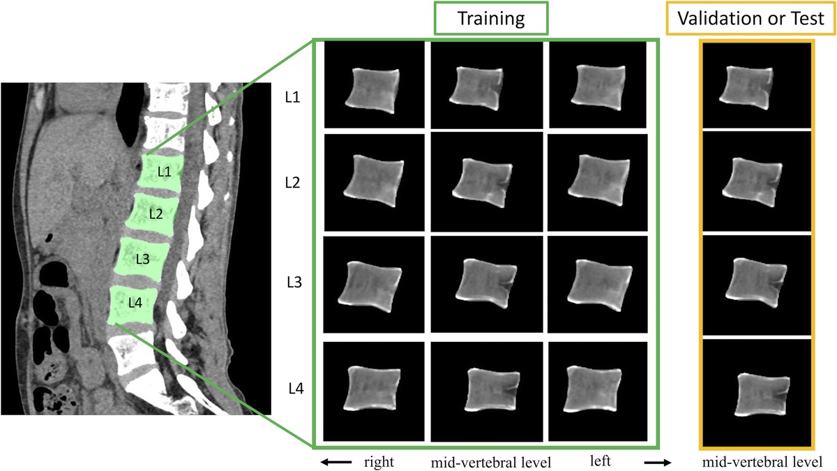 Feasibility of Bone Mineral Density and Bone Microarchitecture Assessment Using Deep Learning With a Convolutional Neural Network