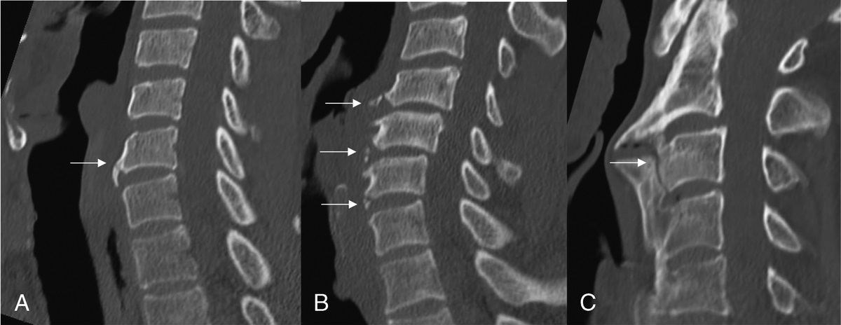 Can Anterior Osteophyte Fractures Be Distinguished From Fracture Mimics in the Subaxial Cervical Spine? A Retrospective Analysis Evaluating Reported Fractures With Clinical Management Correlation