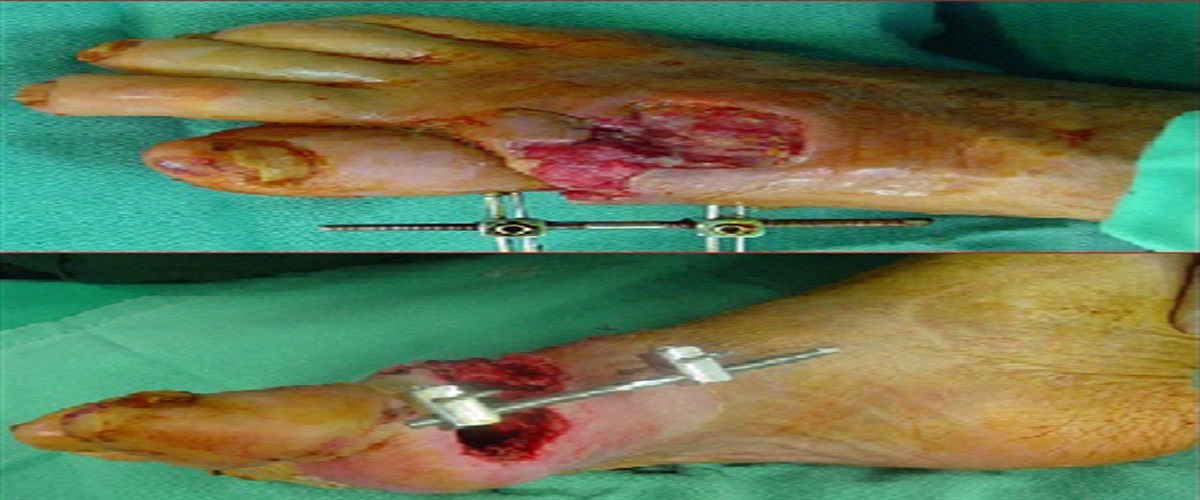 Limb Salvage in Diabetic Patients With Combination of Radical Excision, Antibiotic Impregnated Bone Cement, and External Fixator Application