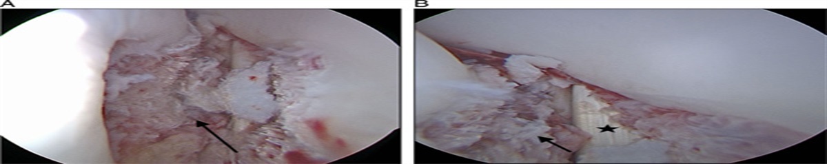 Deltoid Ligament Reconstruction: An Arthroscopic-assisted, Limited Open Knotless Approach Utilizing Suture Tape Augmentation