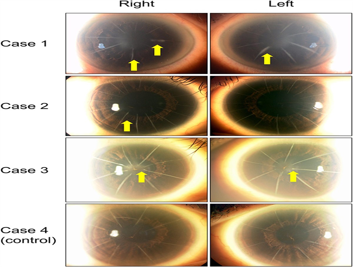 Long-Term Corneal Refractive Power Changes Two Decades After Radial Keratotomy With Microperforations