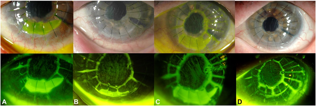 Early Postoperative Therapeutic Scleral Lens Intervention for Penetrating Keratoplasty Complications in Atopic Keratoconjunctivitis