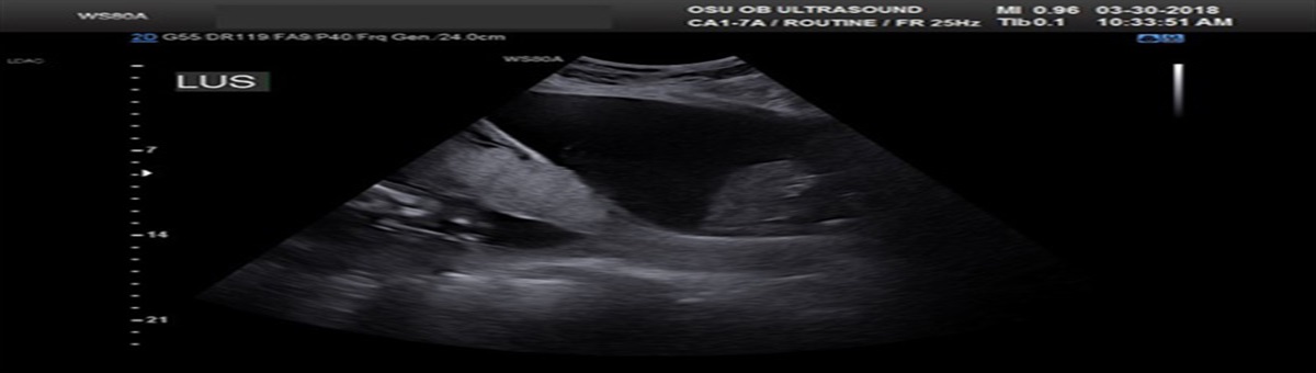 Placenta Accreta Spectrum and Postpartum Hemorrhage