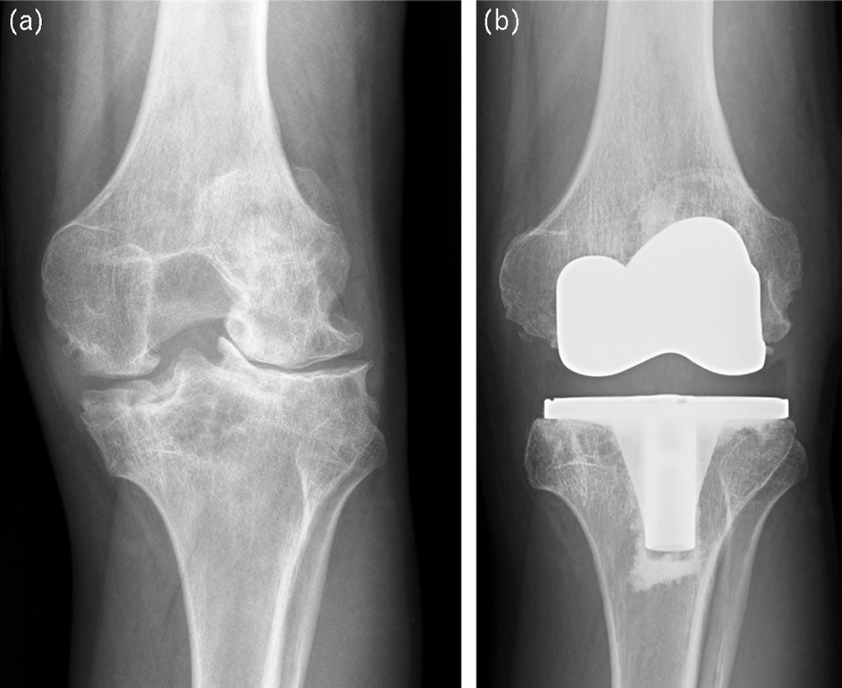 Orthopedic surgical procedures in people with hemophilia