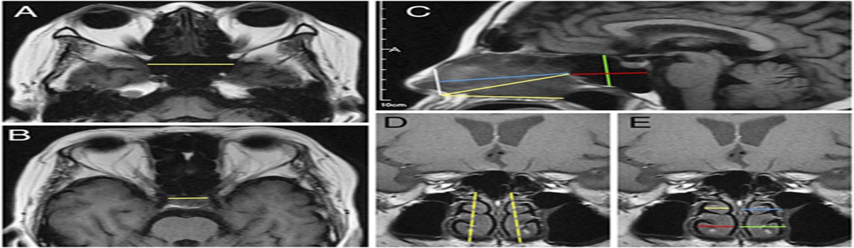 Nasal and Sellar Anatomic Variations in Pituitary-Dependent Cushing Disease