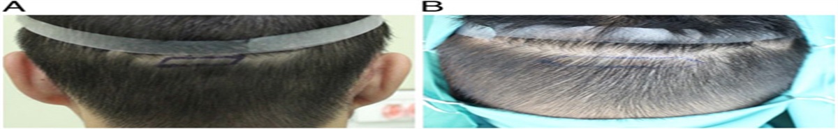 Comparison of 2 Incisional Methods in Hair Transplantation