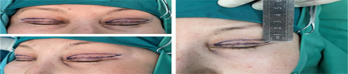 Long-Term Effects of Extended Upper Blepharoplasty Combined With Subbrow Skin Removal for Correction of Lateral Hooding in Asian Women