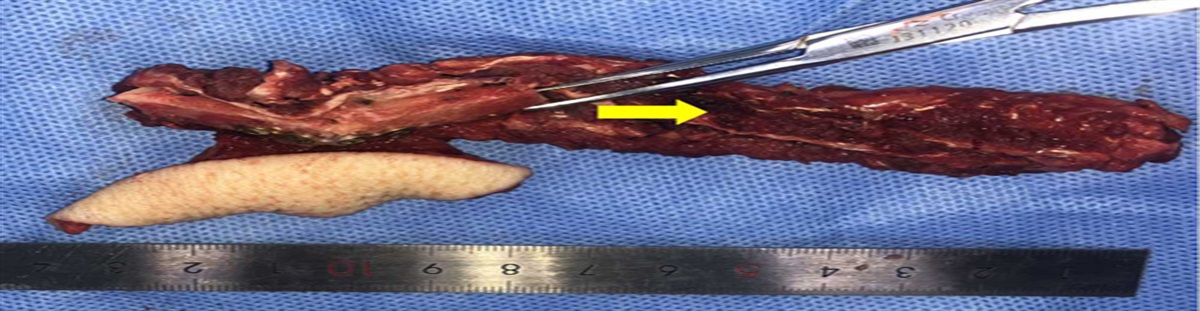 Vascular Pedicle Ossification After Jaw Reconstruction With Fibular Free Flap