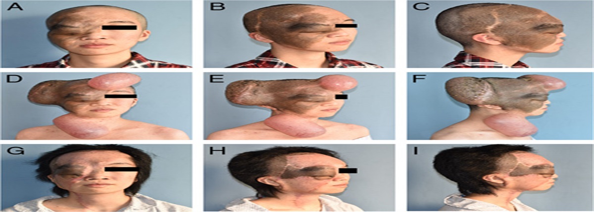 Expansion Technique for Reconstruction of Craniofacial Defect after Plexiform Neurofibroma Excision