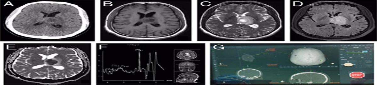 Robot-Guided Stereotactic Puncture and Drainage in the Treatment of Thalamic Abscess