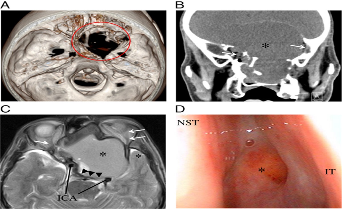 Bilateral Rhinogenous Optic Neuropathy Caused by the Regrowth of a Large Sphenoid Sinus Mucocele