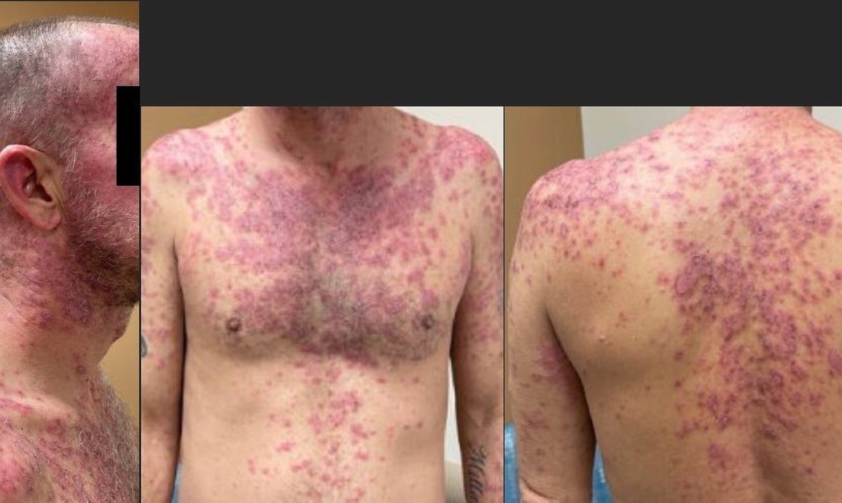 Aripiprazole-Induced Stevens-Johnson Syndrome/Toxic Epidermal Necrolysis: A Case Study