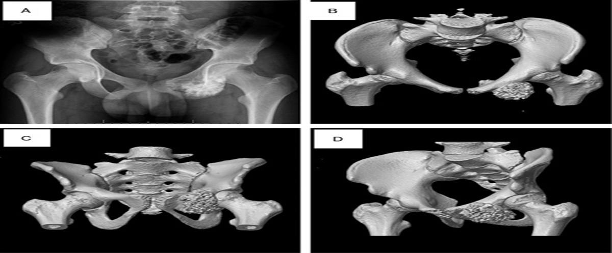 Excision of a Superior Ramus Osteochondroma Through the Modified Stoppa Approach