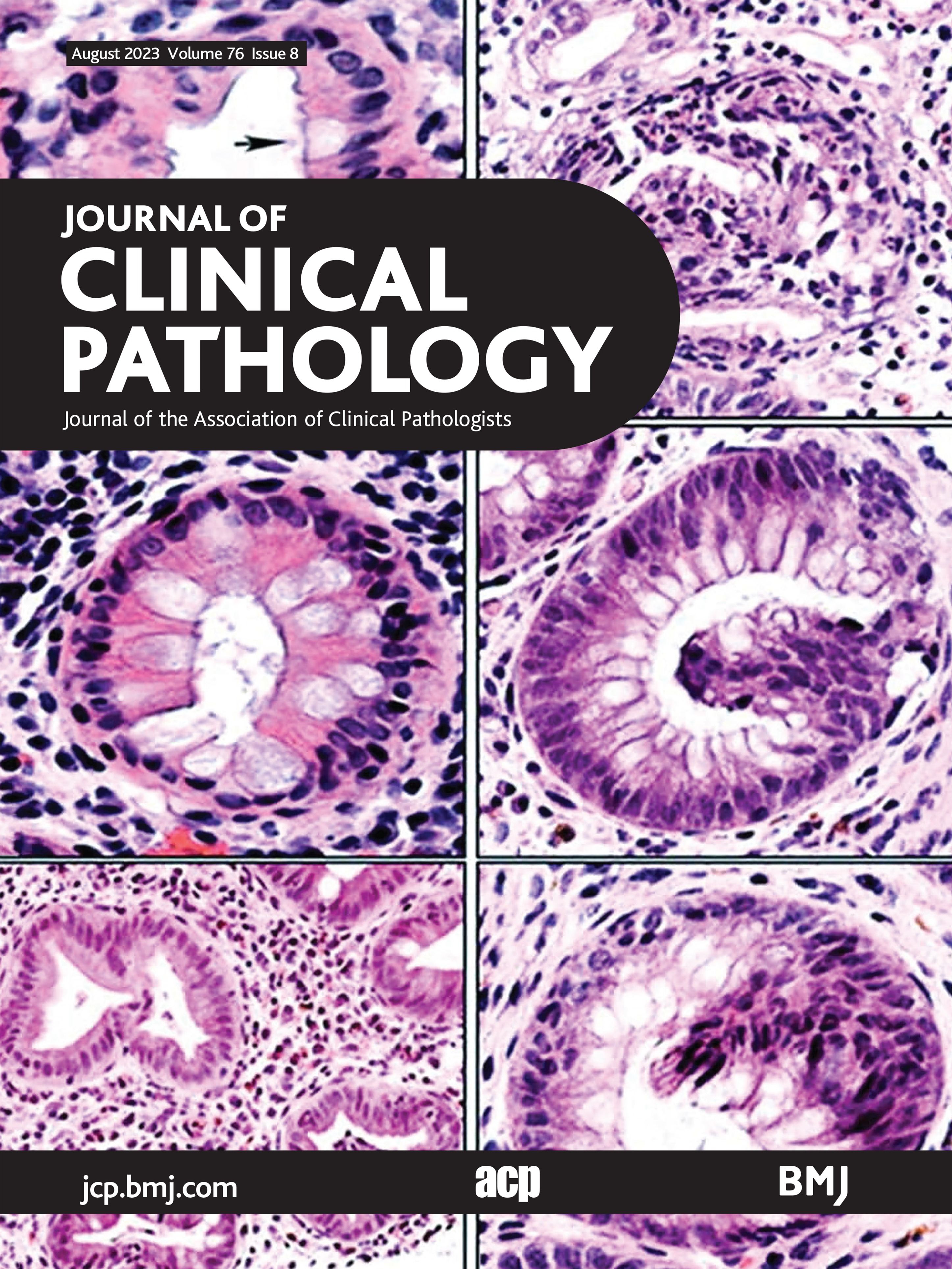Factors predicting BRCA1/2 pathogenic variants in patients with ovarian cancer: a systematic review with meta-analysis