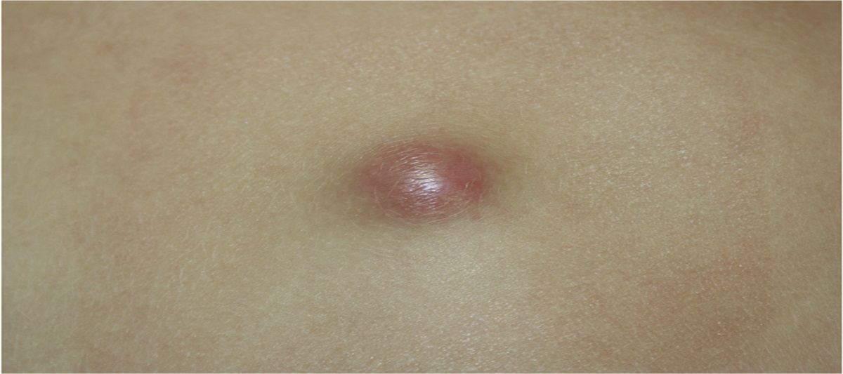 Skin Cancer: Back to Basics: Dermatofibrosarcoma Protuberans