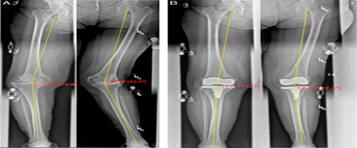 An Extramedullary Spacing Block Technique to Restore Native Coronal Limb Alignment in TKA