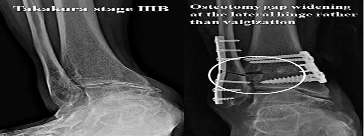 Protective Kirschner Wire Fixation to Reduce the Effect of Lateral Hinge Fracture During the Medial Opening Wedge Low Tibial Osteotomy: A Technical Note