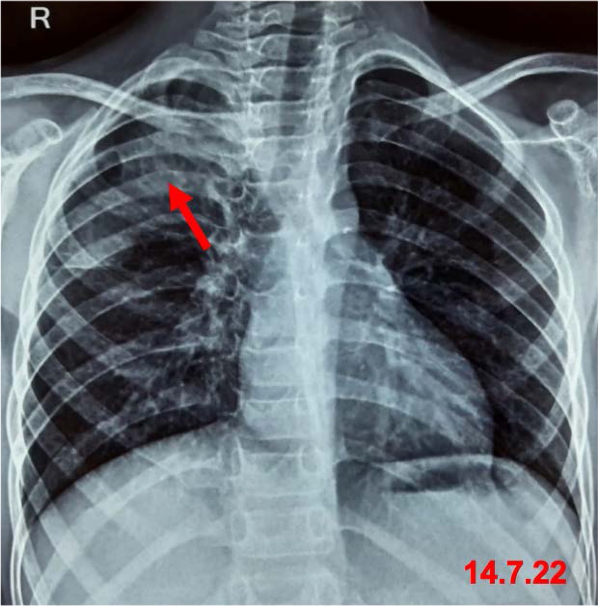 A Child With a Brief History of Coughing Up Blood