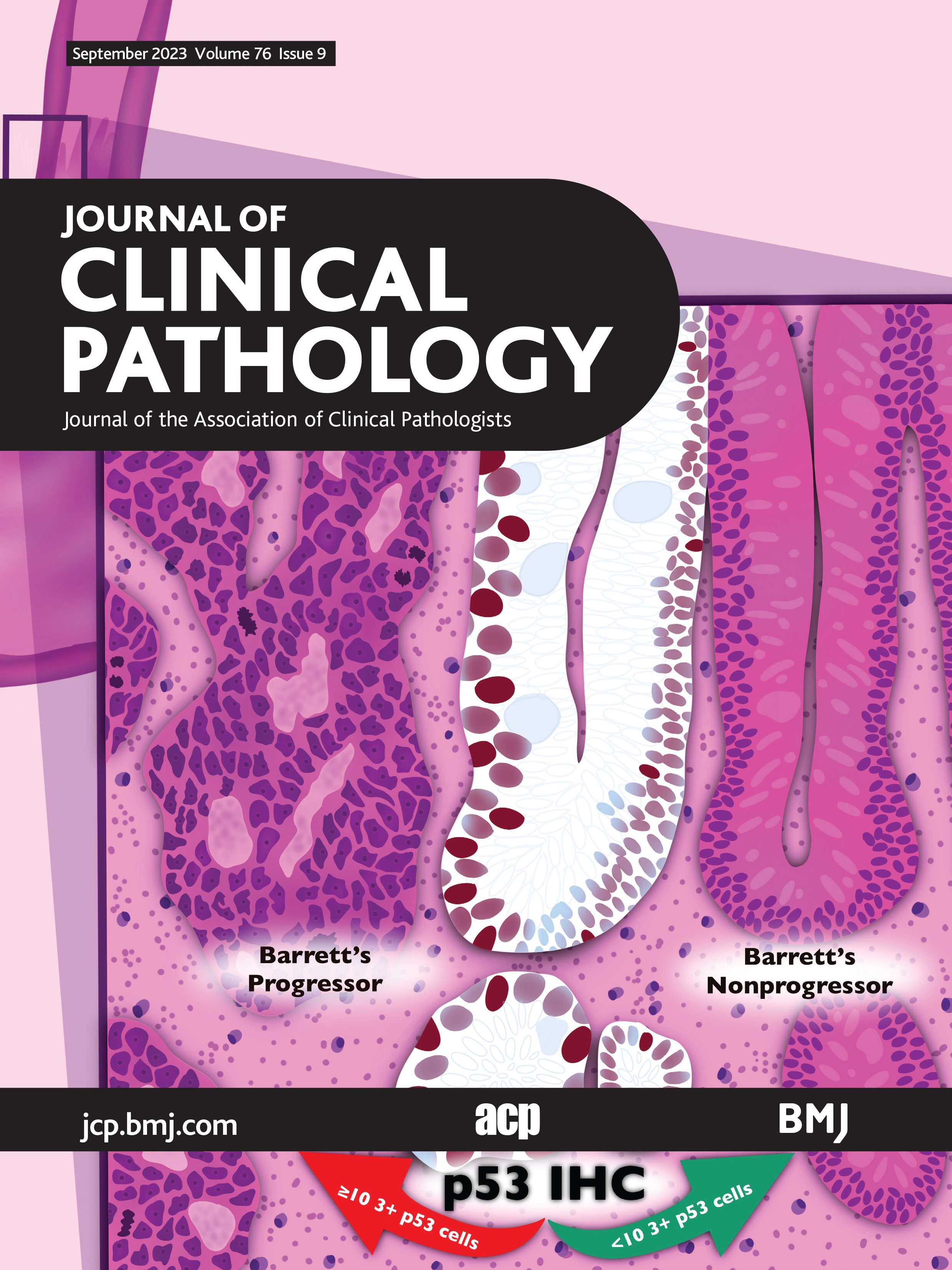 MYCN amplification and International Neuroblastoma Risk Group stratification on fine-needle aspiration biopsy and their correlation to survival in neuroblastoma