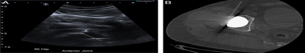 Ultrasound-guided Tenotomy and Osteectomy for the Treatment of Iliopsoas Impingement Post-total Hip Replacement
