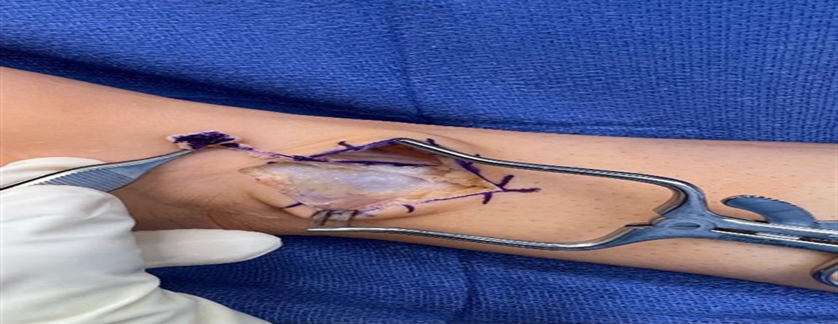 The Use of a Collagen Conduit for Transposing an Iatrogenic Saphenous Nerve Neuroma: A Surgical Technique