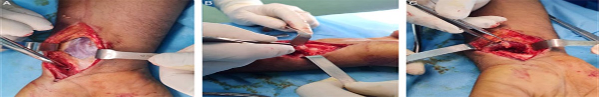 Vascularized pronator quadratus pedicled bone grafting versus iliac crest bone grafting in the treatment of scaphoid nonunion: a retrospective study