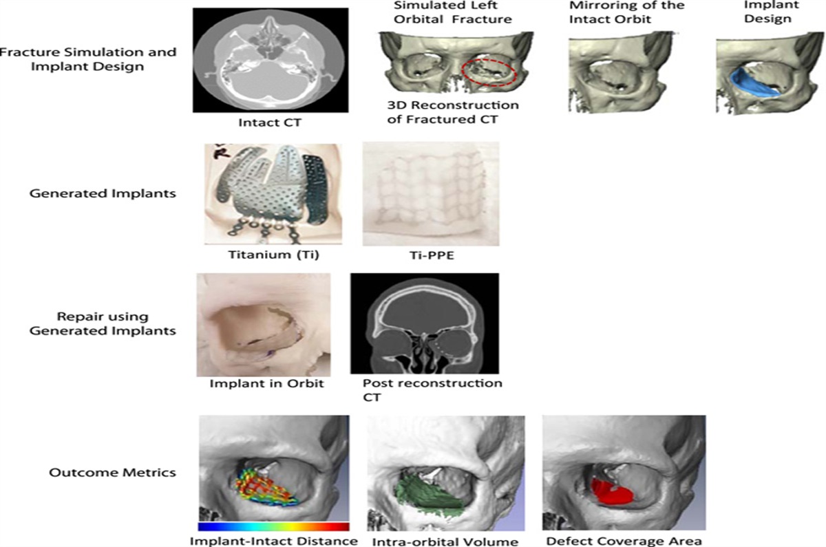 Accuracy of Orbital Shape Reconstruction—Comparative Analysis of Errors in Implant Shape Versus Implant Positioning: A Cadaveric Study