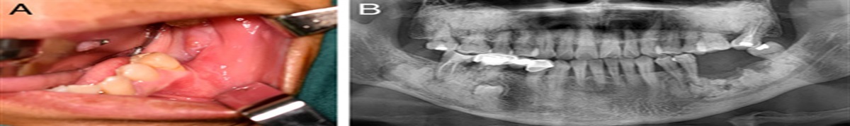 Surgical Management of Infection Secondary to Cemento-osseous Dysplasia