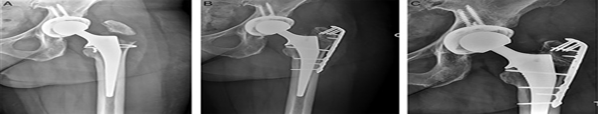 Novel Use of Olecranon Locking Plate With Achilles Allograft Augmentation for Fixation of Greater Trochanter Fractures After Total Hip Replacement