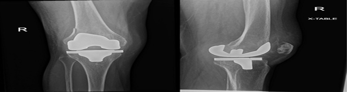 Intramedullary Fibular Strut Allograft and a Small Fragment Nonlocking T-plate for Periprosthetic Lateral Femoral Condyle Fracture: A Case Report