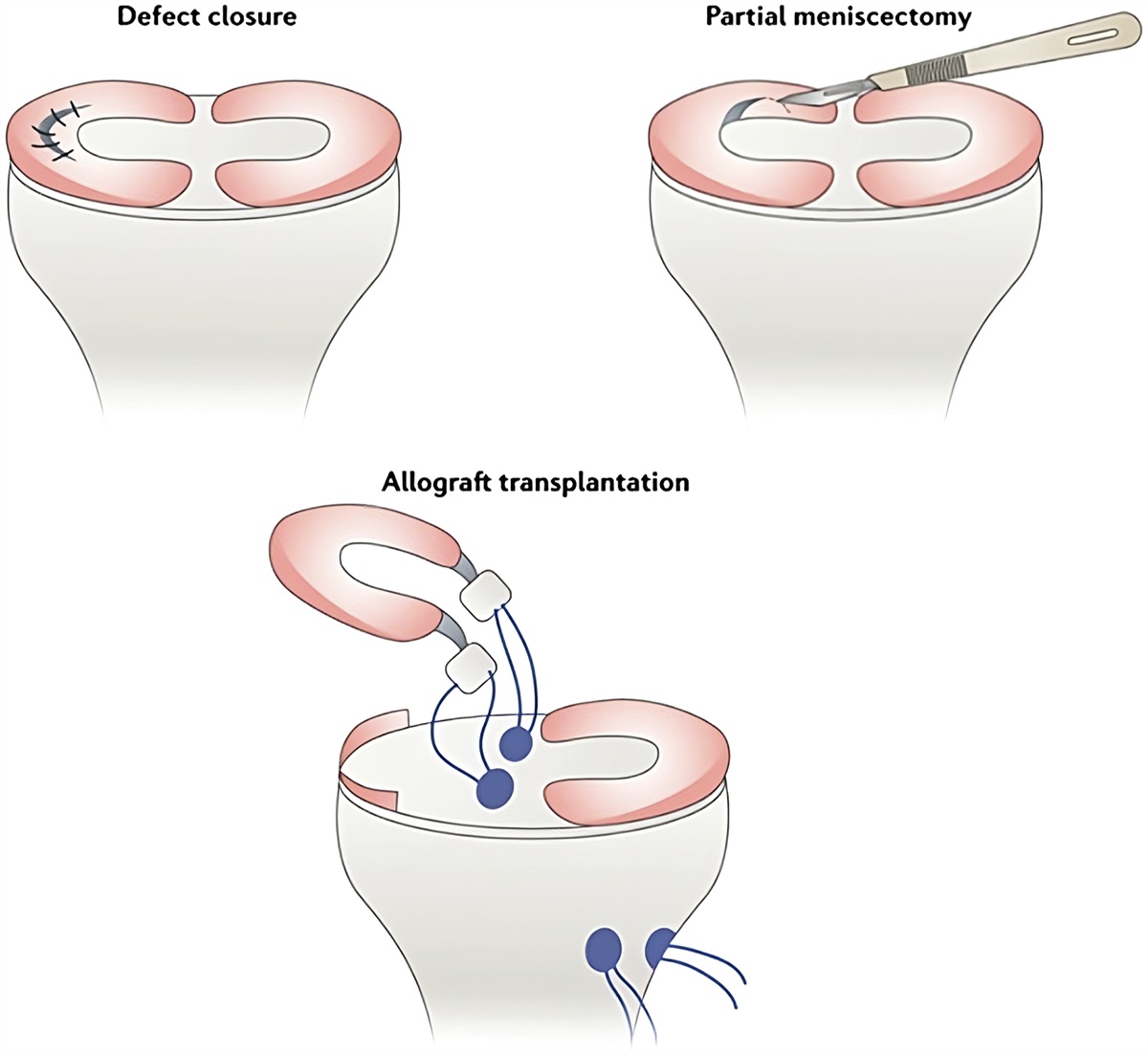 A Transplant or a Patch? A Review of the Biologic Integration of Meniscus Allograft Transplantation