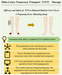 Efficacy and safety of unilateral tibial cortex transverse transport on bilateral diabetic foot ulcers: A propensity score matching study