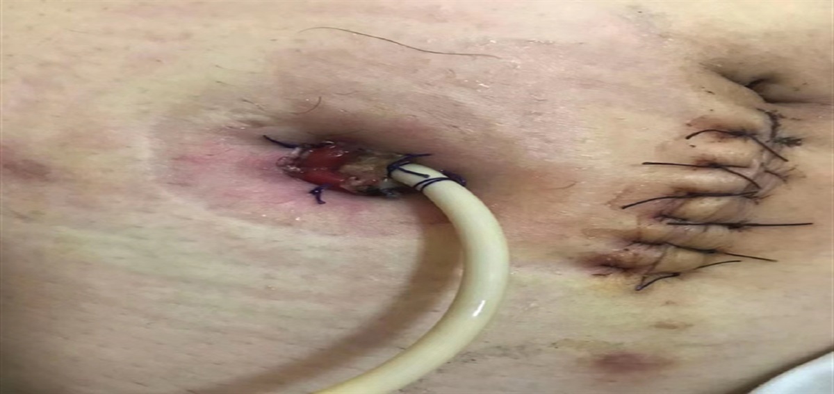 Negative Pressure Wound Therapy for Patients With Complicated Mucocutaneous Separation Following Ileal Conduit Urinary Diversion: A Case Series