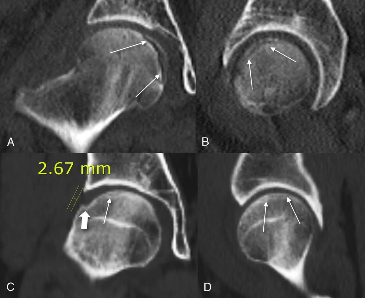 What Is New in Stage 3 of the 2019 Revised Association Research Circulation Osseous Staging System of Osteonecrosis of the Femoral Head: A Relationship to Bone Resorption