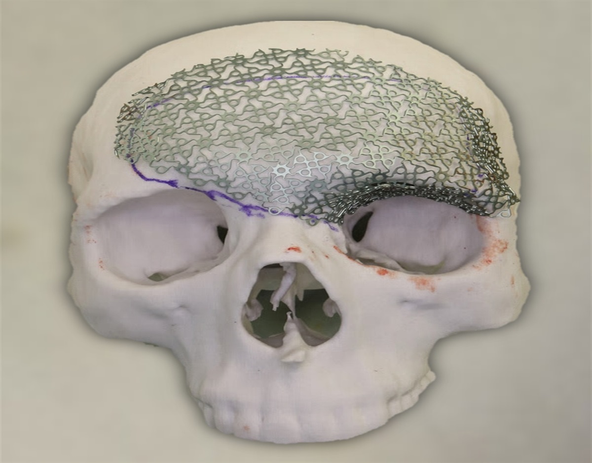 A Comparative Study of Titanium Cranioplasty for Extensive Calvarial Bone Defects: Three-Dimensionally Printed Titanium Implants Versus Premolded Titanium Mesh