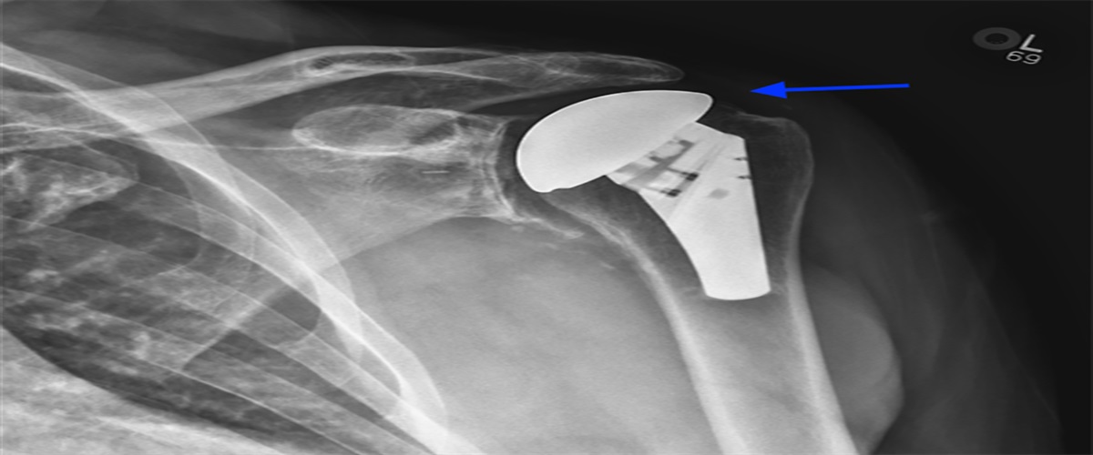 Secondary Rotator Cuff Insufficiency After Anatomic Total Shoulder Arthroplasty