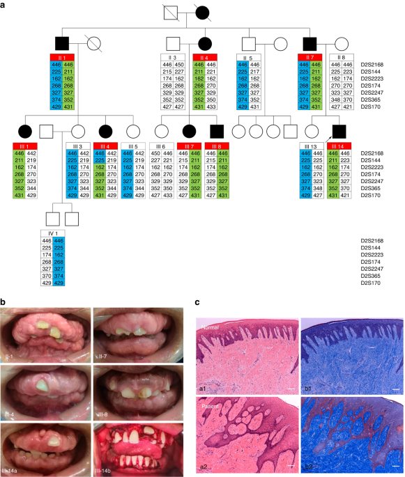Double heterozygous pathogenic mutations in KIF3C and ZNF513 cause hereditary gingival fibromatosis