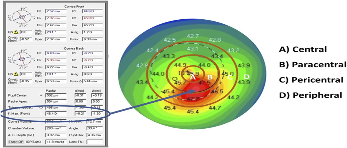 Correlation of Manifest Refraction and Simulated Keratometry to Tomography Characteristics in Patients With Keratoconus